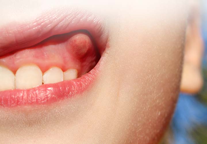 Gum Disease eyeSMILE