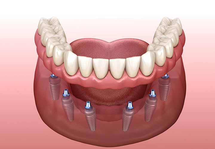 Denture Stabilization eyeSMILE